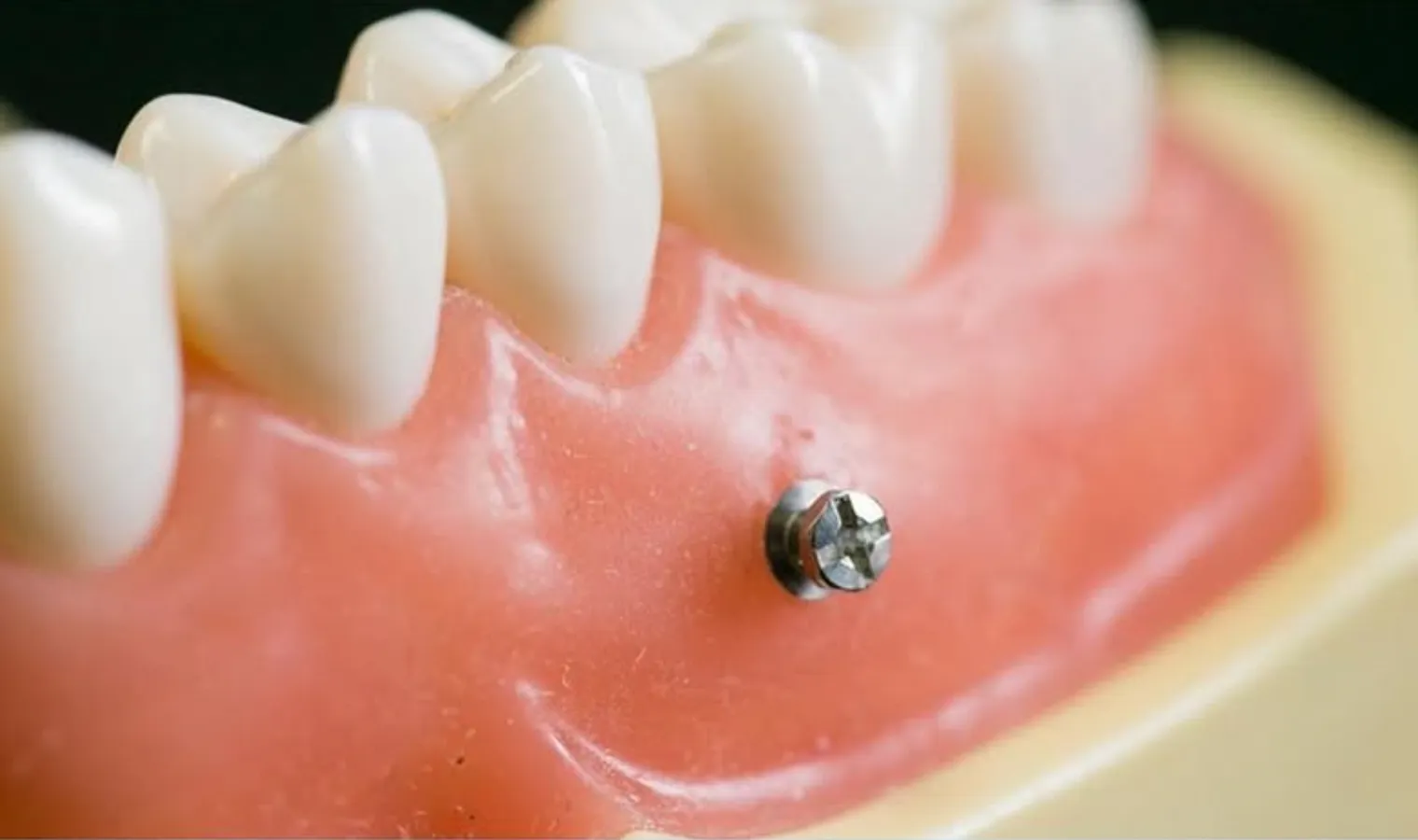 アンカースクリュー