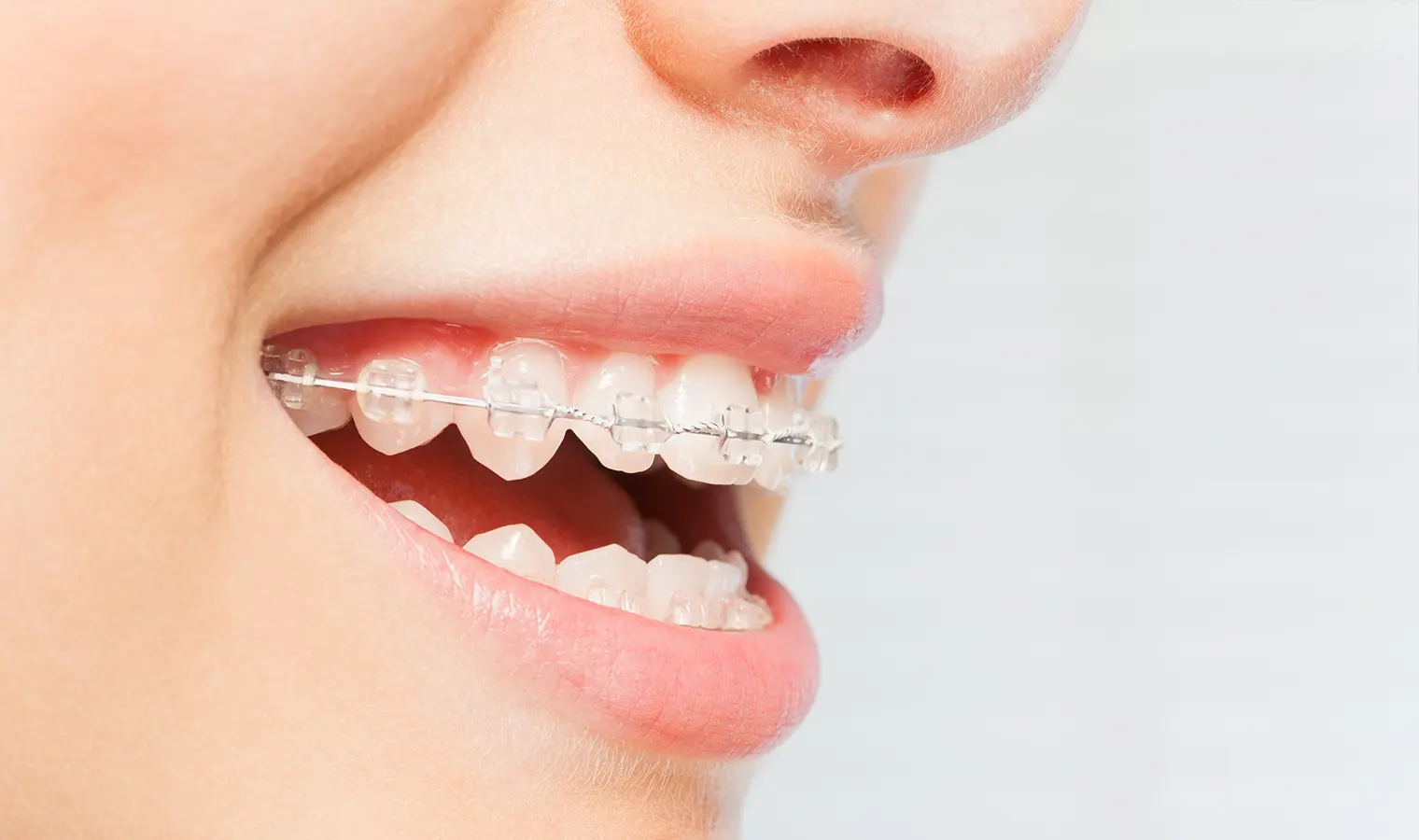 ワイヤー矯正装置